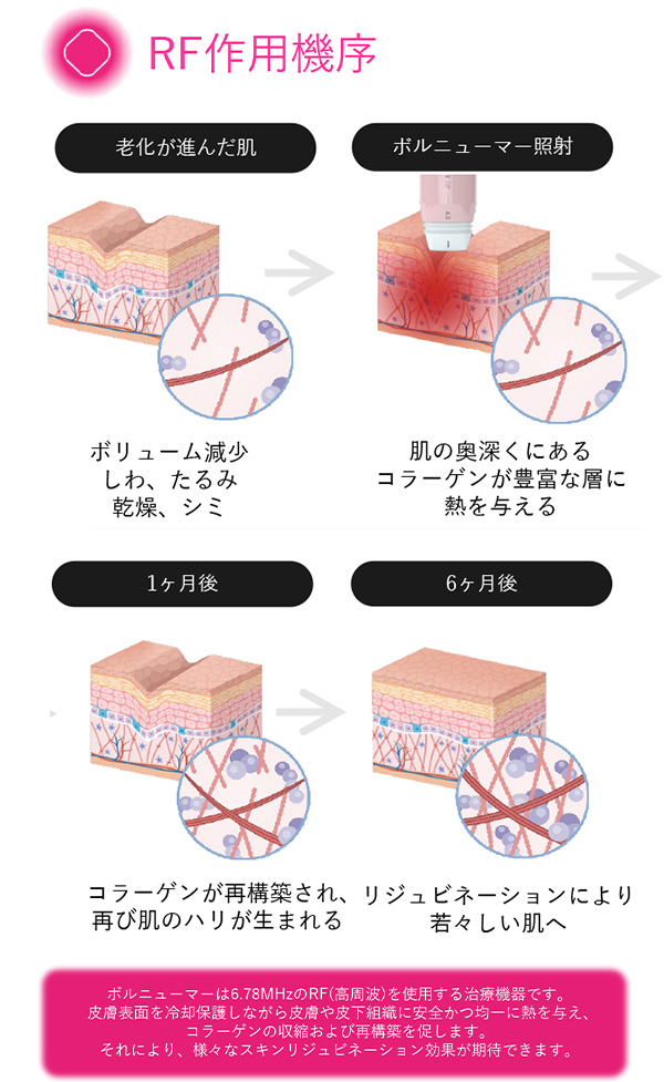 ボルニューマーのリフトアップ・たるみ改善・引き締めメカニズム（肌の老化／ボルニューマー照射／1か月後／6か月後）