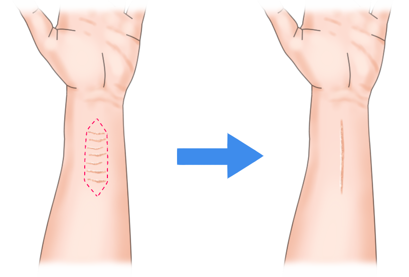 リストカット 術前・術後のイメージ画