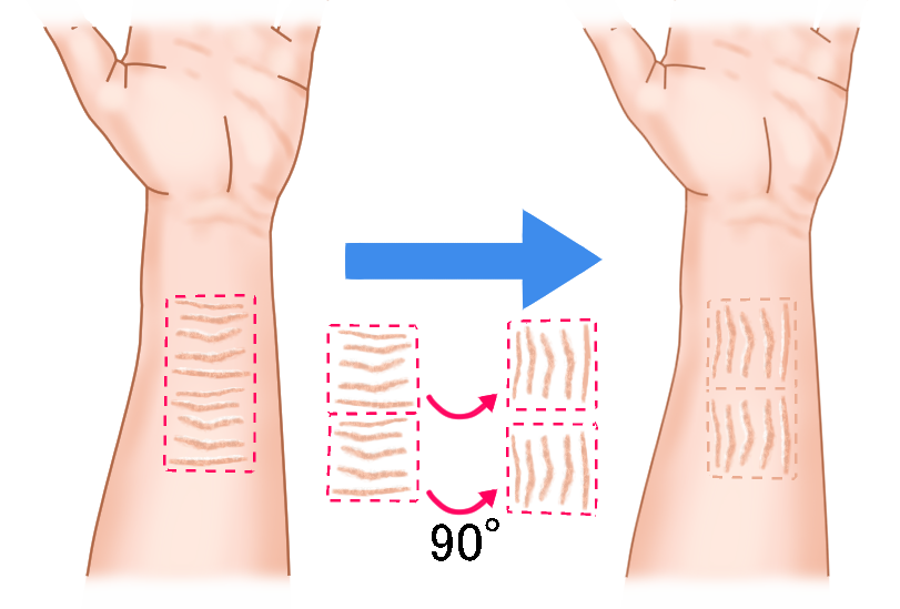 リストカット 術前・術後のイメージ画